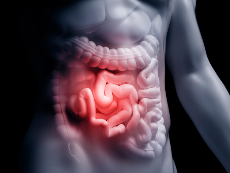 Doenças Inflamatórias Intestinais - Dra. Gabriela Dalfior Ferreira